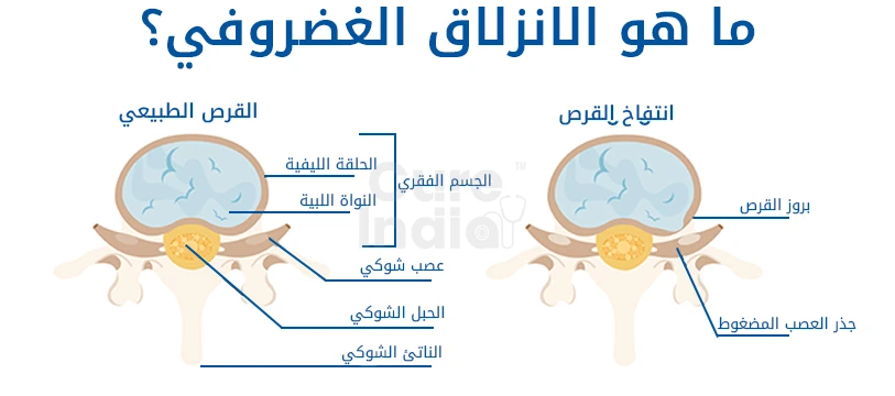 ما هو انتفاخ القرص